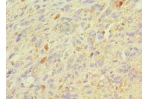 Immunohistochemistry of paraffin-embedded human melanoma using ABIN7154393 at dilution of 1:100 (Granulin 抗体  (AA 20-310))
