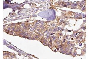 ABIN6272998 at 1/100 staining Human breast cancer tissue by IHC-P. (ENOX2 抗体  (N-Term))