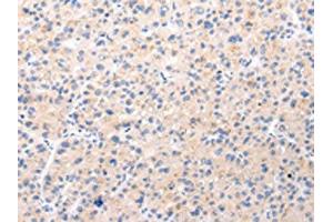 The image on the left is immunohistochemistry of paraffin-embedded Human liver cancer tissue using ABIN7190022(BSN Antibody) at dilution 1/20, on the right is treated with synthetic peptide. (Bassoon 抗体)