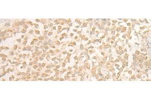 Immunohistochemistry of paraffin-embedded Human ovarian cancer tissue using DUSP27 Polyclonal Antibody at dilution of 1:50(x200) (DUSP27/STYXL2 抗体)