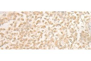Immunohistochemistry of paraffin-embedded Human ovarian cancer tissue using DUSP27 Polyclonal Antibody at dilution of 1:50(x200) (DUSP27/STYXL2 抗体)