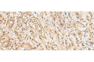 Immunohistochemistry of paraffin-embedded Human liver cancer tissue using NUDT12 Polyclonal Antibody at dilution of 1:25(x200) (NUDT12 抗体)