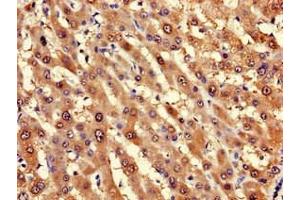 Immunohistochemistry of paraffin-embedded human liver cancer using ABIN7143224 at dilution of 1:100 (LPGAT1 抗体  (AA 151-341))