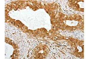 The image on the left is immunohistochemistry of paraffin-embedded Human cervical cancer tissue using ABIN7131317(TEKT1 Antibody) at dilution 1/30, on the right is treated with fusion protein. (TEKT1 抗体)