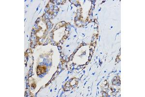 Immunohistochemistry of paraffin-embedded Human thyroid cancer using CYP51 Rabbit pAb (3485) at dilution of 1:50 (40x lens). (CYP51A1 抗体  (AA 210-509))