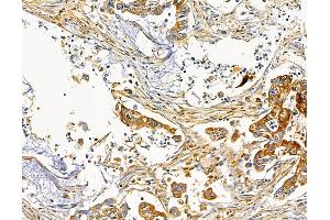 ABIN7095732 and ABIN7099794 at 1/100 staining human pancreatic cancer by IHC-P. (KCNIP2 抗体)