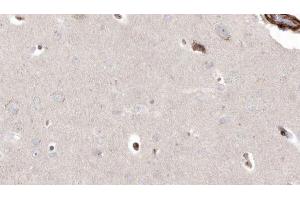 ABIN6272927 at 1/100 staining Human brain cancer tissue by IHC-P.