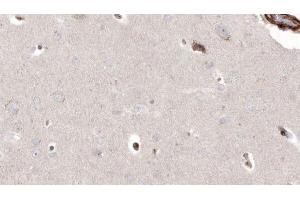 ABIN6272927 at 1/100 staining Human brain cancer tissue by IHC-P. (PIEZO1 抗体  (Internal Region))