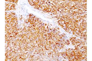 Formalin-fixed, paraffin-embedded human Melanoma stained with Melanoma Marker Mouse Monoclonal Antibody (DT101+ BC199 + HMB45). (MLANA & SILV 抗体)