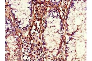 Immunohistochemistry of paraffin-embedded human colon cancer using ABIN7155925 at dilution of 1:100