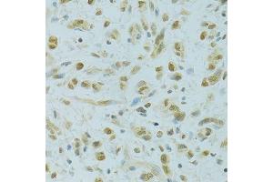 Immunohistochemistry of paraffin-embedded human gastric cancer using RCC1 antibody. (RCC1 抗体  (AA 1-240))