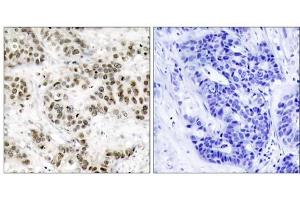 Immunohistochemical analysis of paraffin-embedded human breast carcinoma tissue using SAPK/JNK (Ab-185) antibody (E021242). (SAPK, JNK 抗体)