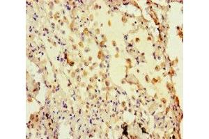 Immunohistochemistry of paraffin-embedded human lung cancer using ABIN7155425 at dilution of 1: 100 (Histone 3 抗体  (AA 2-30))