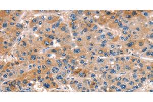 Immunohistochemistry of paraffin-embedded Human liver cancer tissue using ALOX15 Polyclonal Antibody at dilution 1:50 (ALOX15 抗体)