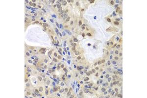 Immunohistochemistry of paraffin-embedded human oophoroma using MCM3 antibody at dilution of 1:100 (400x lens). (MCM3 抗体)