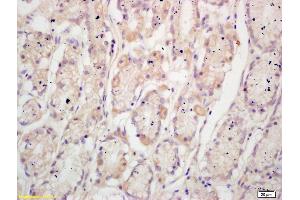 Formalin-fixed and paraffin embedded human gastric cancer labeled with Anti-TFF2 Polyclonal Antibody, Unconjugated (ABIN736403) at 1:200 followed by conjugation to the secondary antibody and DAB staining (Trefoil Factor 2 抗体  (AA 51-129))