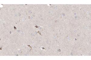 ABIN6272925 at 1/100 staining Human brain cancer tissue by IHC-P. (MLYCD 抗体  (Internal Region))