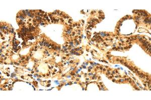 Immunohistochemistry of paraffin-embedded Human thyroid cancer tissue using SERPINB1 Polyclonal Antibody at dilution 1:30 (SERPINB1 抗体)