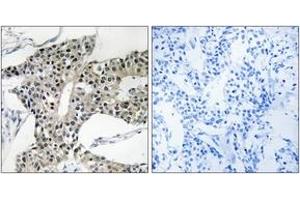 Immunohistochemistry analysis of paraffin-embedded human breast carcinoma tissue, using ARSK Antibody. (Arylsulfatase K 抗体  (AA 481-530))