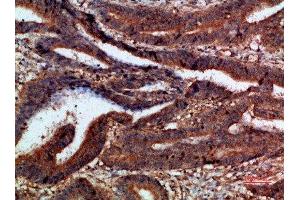 Immunohistochemical analysis of paraffin-embedded human-colon-cancer, antibody was diluted at 1:200 (CTNND1 抗体  (AA 841-890))
