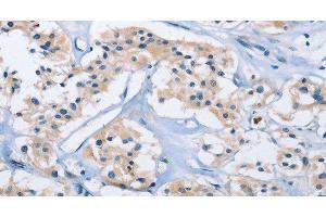 Immunohistochemistry of paraffin-embedded Human thyroid cancer using CARD14 Polyclonal Antibody at dilution of 1:30 (CARD14 抗体)