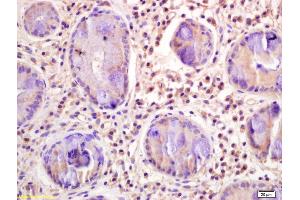 Formalin-fixed and paraffin embedded human gastric carcinoma labeled with Rabbit Anti CD33/Siglec-3 Polyclonal Antibody, Unconjugated (ABIN676958) at 1:200 followed by conjugation to the secondary antibody and DAB staining (CD33 抗体  (AA 261-364))
