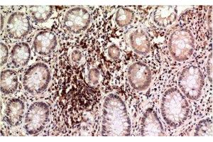 Immunohistochemistry of paraffin-embedded Human colon carcinoma tissue using Epsilon Tubulin Monoclonal Antibody at dilution of 1:200. (TUBE1 抗体)