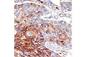 Immunohistochemistry of paraffin-embedded human esophageal cancer using ORM1/2 Rabbit mAb (ABIN7269114) at dilution of 1:100 (40x lens). (Orosomucoid 2 抗体)