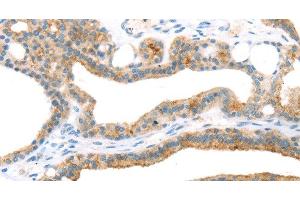 Immunohistochemistry of paraffin-embedded Human thyroid cancer using TNIP2 Polyclonal Antibody at dilution of 1:35 (TNIP2 抗体)