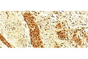 Immunohistochemistry of paraffin-embedded Human esophagus cancer tissue using UNKL Polyclonal Antibody at dilution of 1:50(x200) (UNKL 抗体)