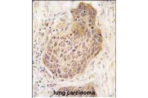 Formalin-fixed and paraffin-embedded human lung carcinoma tissue reacted with RIPK2 Antibody (C-term) (ABIN392274 and ABIN2841944) , which was peroxidase-conjugated to the secondary antibody, followed by DAB staining. (RIPK2 抗体  (C-Term))