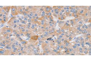 Immunohistochemistry of paraffin-embedded Human liver cancer using SLC25A13 Polyclonal Antibody at dilution of 1:35 (slc25a13 抗体)