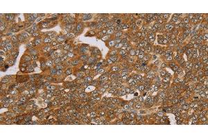 Immunohistochemistry of paraffin-embedded Human cervical cancer using PLEKHG6 Polyclonal Antibody at dilution of 1:45 (PLEKHG6 抗体)