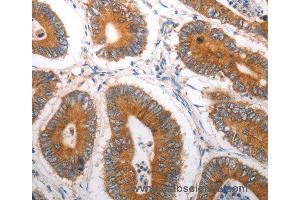 Immunohistochemistry of Human liver cancer using SLC12A6 Polyclonal Antibody at dilution of 1:40 (SLC12A6 抗体)