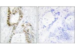 Immunohistochemistry analysis of paraffin-embedded human colon carcinoma, using FANCA (Ab-1149) Antibody. (FANCA 抗体  (AA 1121-1170))