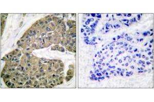 Immunohistochemistry analysis of paraffin-embedded human breast carcinoma tissue, using Keratin 5 Antibody. (Cytokeratin 5 抗体  (AA 541-590))