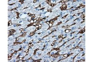 Immunohistochemical staining of paraffin-embedded Carcinoma of liver tissue using anti-MTRF1L mouse monoclonal antibody. (MTRF1L 抗体)