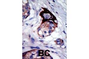 Formalin-fixed and paraffin-embedded human cancer tissue reacted with the primary antibody, which was peroxidase-conjugated to the secondary antibody, followed by AEC staining. (MARK3 抗体  (C-Term))