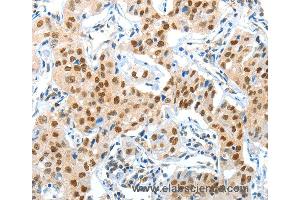 Immunohistochemistry of Human lung cancer using APPL1 Polyclonal Antibody at dilution of 1:70 (APPL1 抗体)