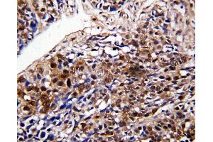 Anti-DDT antibody, IHC(P) IHC(P): Human Lung Cancer Tissue (DDT 抗体  (C-Term))