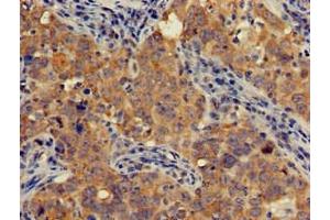 Immunohistochemistry of paraffin-embedded human pancreatic cancer using ABIN7143258 at dilution of 1:100 (AOAH 抗体  (AA 180-254))