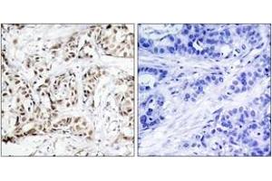 Immunohistochemistry analysis of paraffin-embedded human breast carcinoma, using SAPK/JNK (Phospho-Thr183) Antibody. (SAPK, JNK (AA 151-200), (pThr183) 抗体)