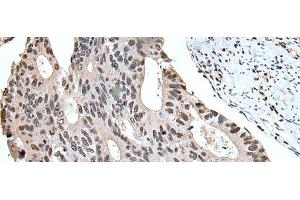 Immunohistochemistry of paraffin-embedded Human colorectal cancer tissue using ZBTB10 Polyclonal Antibody at dilution of 1:100(x200) (ZBTB10 抗体)