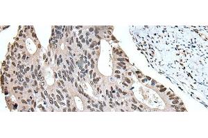 Immunohistochemistry of paraffin-embedded Human colorectal cancer tissue using ZBTB10 Polyclonal Antibody at dilution of 1:100(x200)