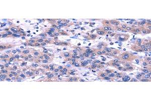 Immunohistochemistry of paraffin-embedded Human liver cancer using TRIM49 Polyclonal Antibody at dilution of 1/40 (TRIM49 抗体)