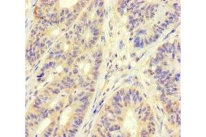 Immunohistochemistry of paraffin-embedded human colon cancer using ABIN7159762 at dilution of 1:100 (MAPRE1 抗体  (AA 2-268))