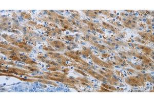 Immunohistochemistry of paraffin-embedded Human liver cancer tissue using PSMD11 Polyclonal Antibody at dilution 1:50 (PSMD11 抗体)