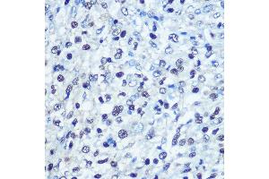 Immunohistochemistry of paraffin-embedded human liver cancer using [KO Validated] S Rabbit pAb (ABIN6132834, ABIN6147368, ABIN6147369 and ABIN7101817) at dilution of 1:100 (40x lens). (SAMHD1 抗体  (AA 387-626))