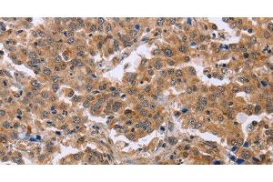 Immunohistochemistry of paraffin-embedded Human liver cancer using EPDR1 Polyclonal Antibody at dilution of 1:40 (EPDR1 抗体)