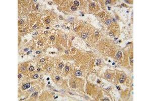 IHC analysis of FFPE human hepatocarcinoma tissue stained with APOA5 antibody (APOA5 抗体  (AA 22-52))
